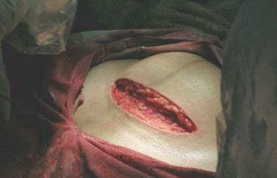震撼!女人现场剖腹产全过程_女性频道_闻康资讯网